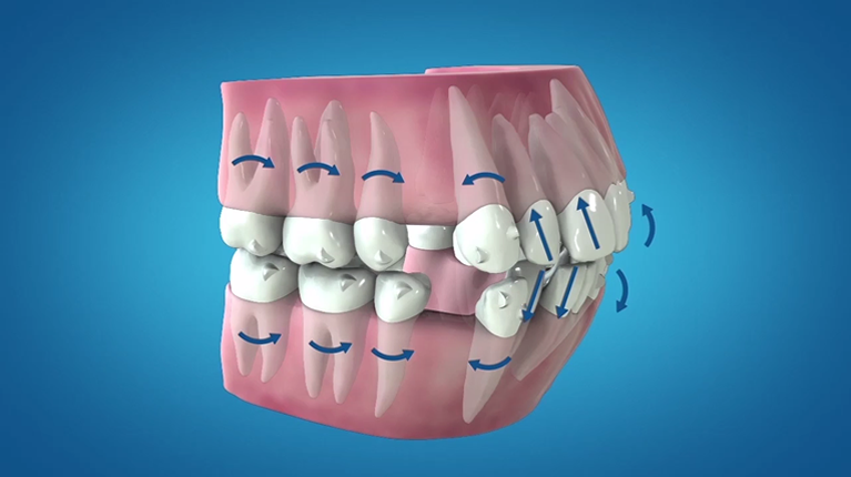 治療前にご自身の歯がどのように動くか確認ができるから安心